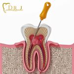 Root Canal Treatment