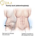 Abdominoplasty